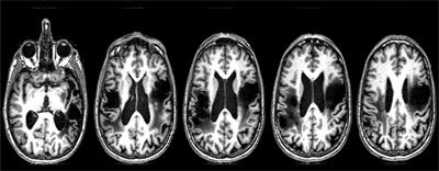 Cerebellar tDCS: A Novel Approach to Augment Language Treatment Post-stroke